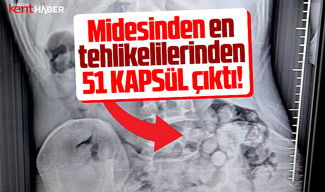 Samsun'da şoke eden röntgen! Midesinden 51 kapsül çıktı!